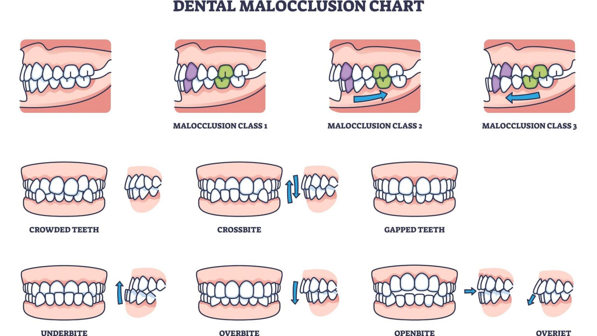 Oklüzyon (Kapanış) Tipleri ve Bozuklukları