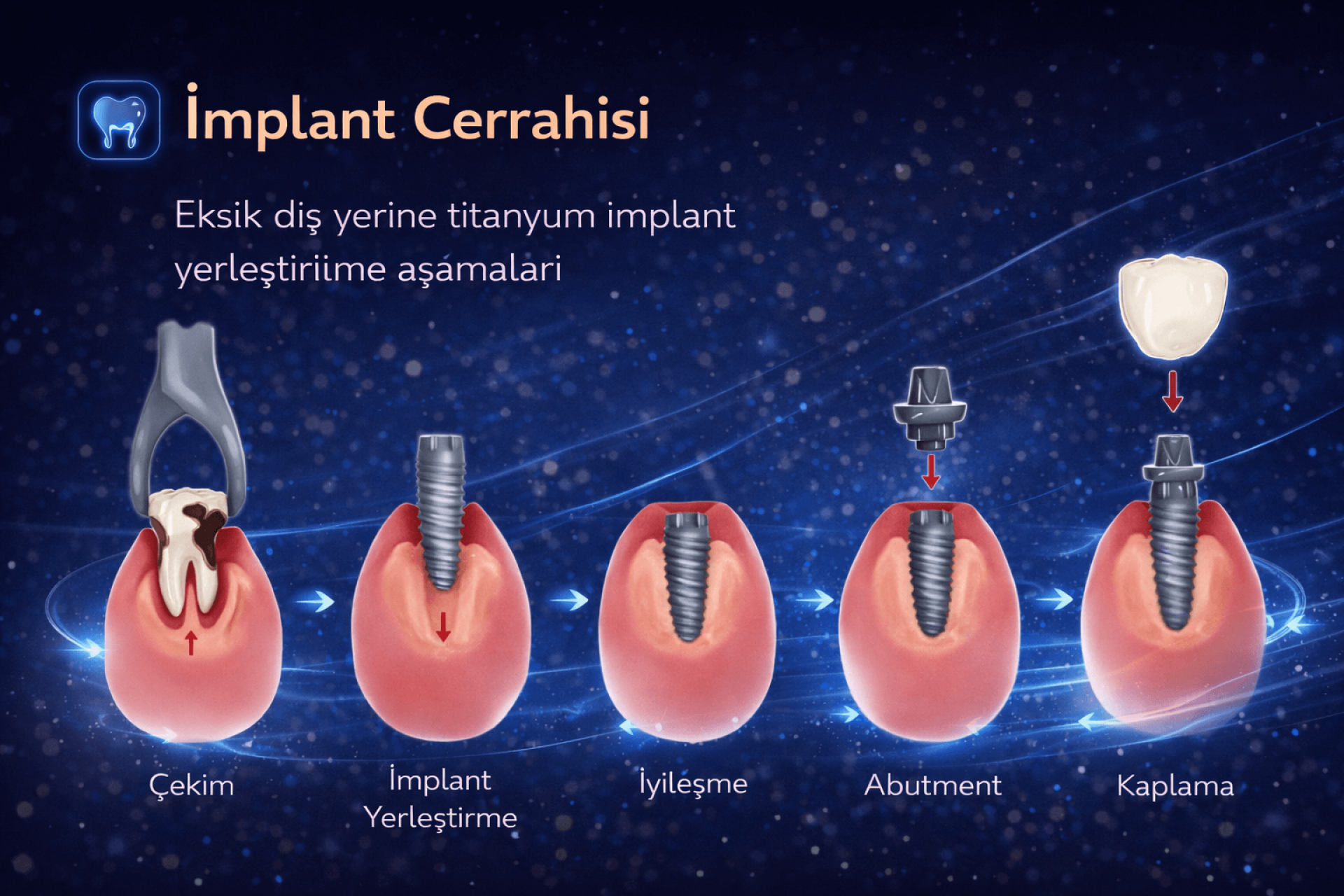 İmplant Cerrahisi