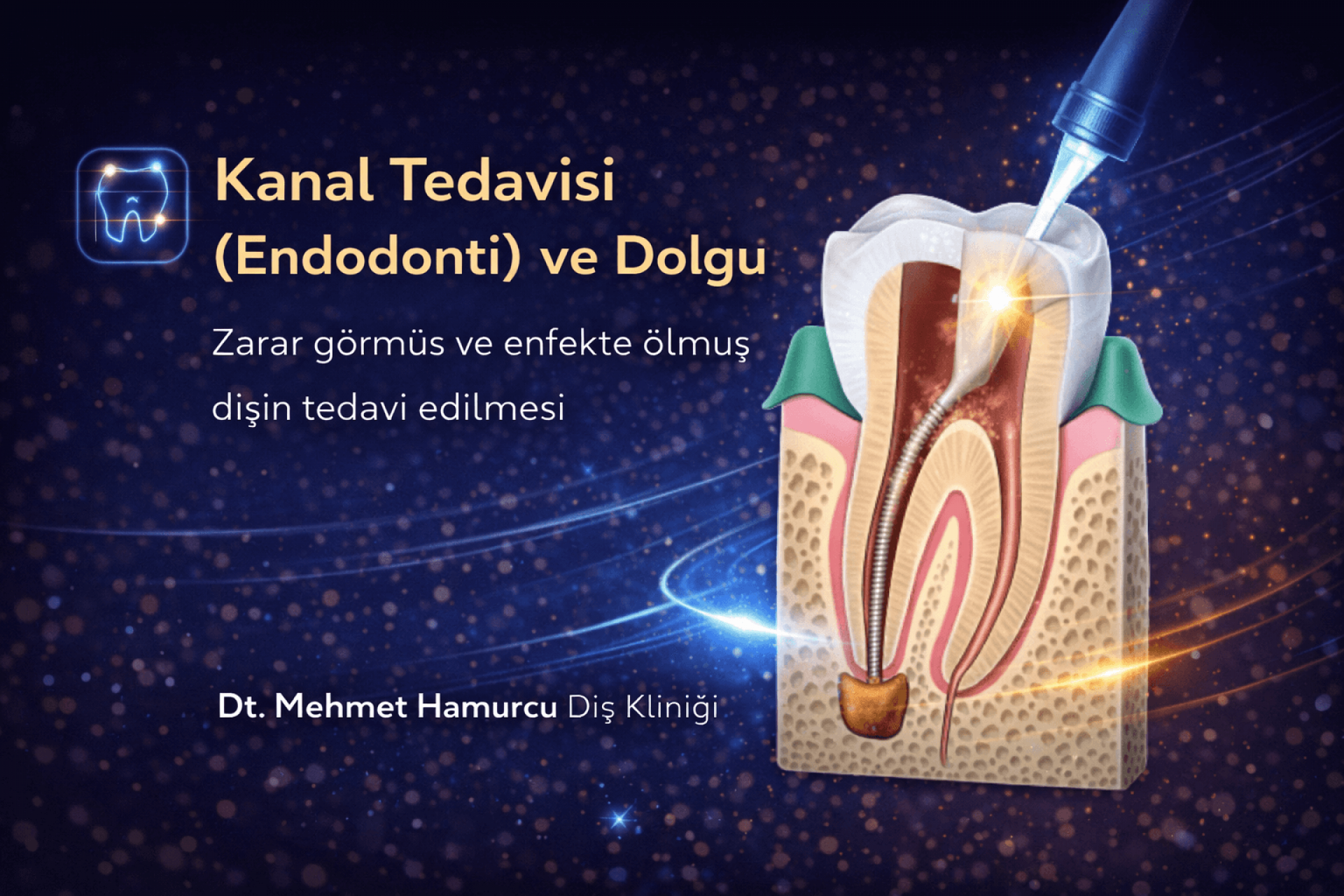 Kanal Tedavisi (Endodonti) ve Dolgu