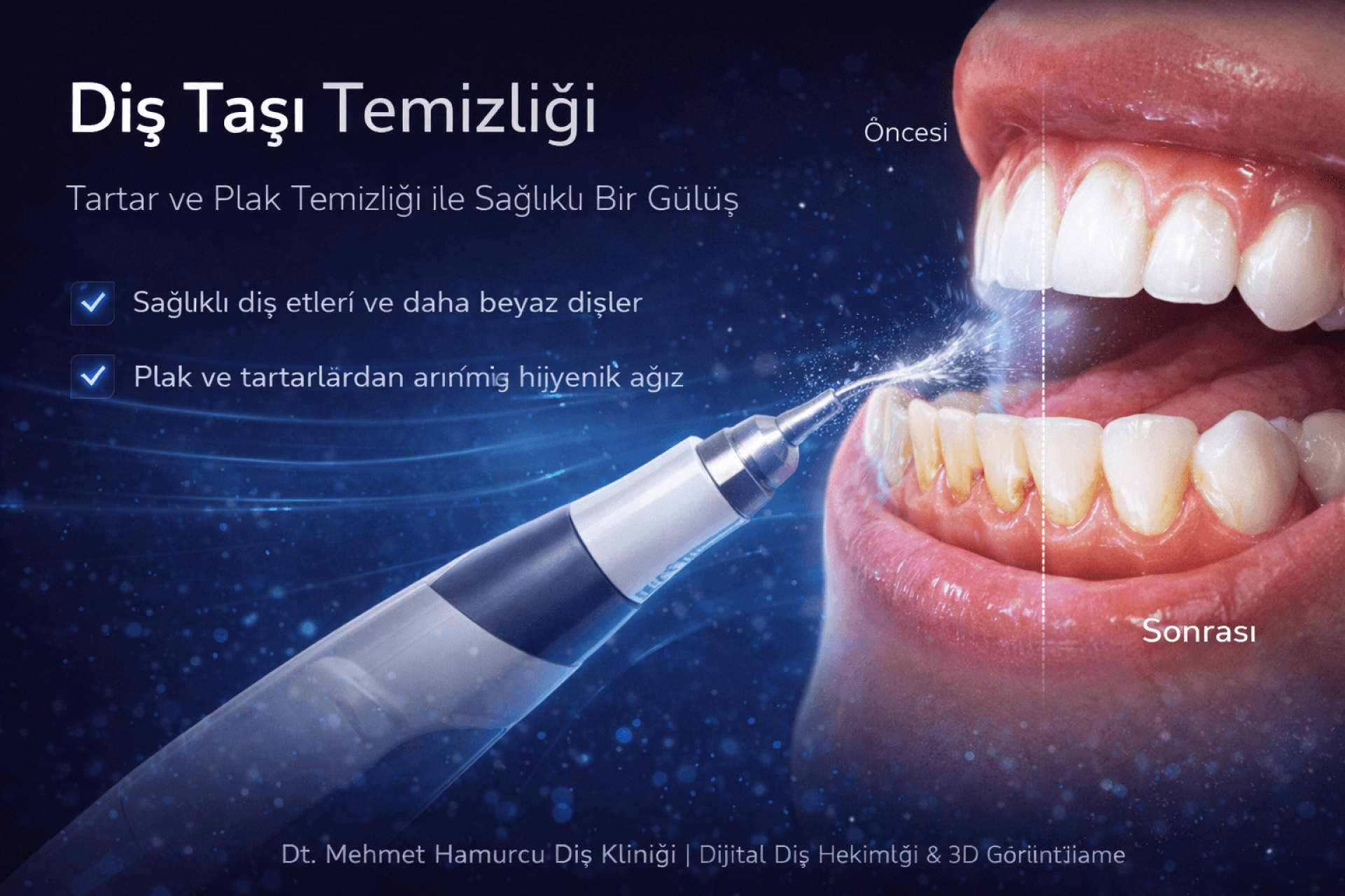 Diş Temizleme ve Beyazlatma İşlemi