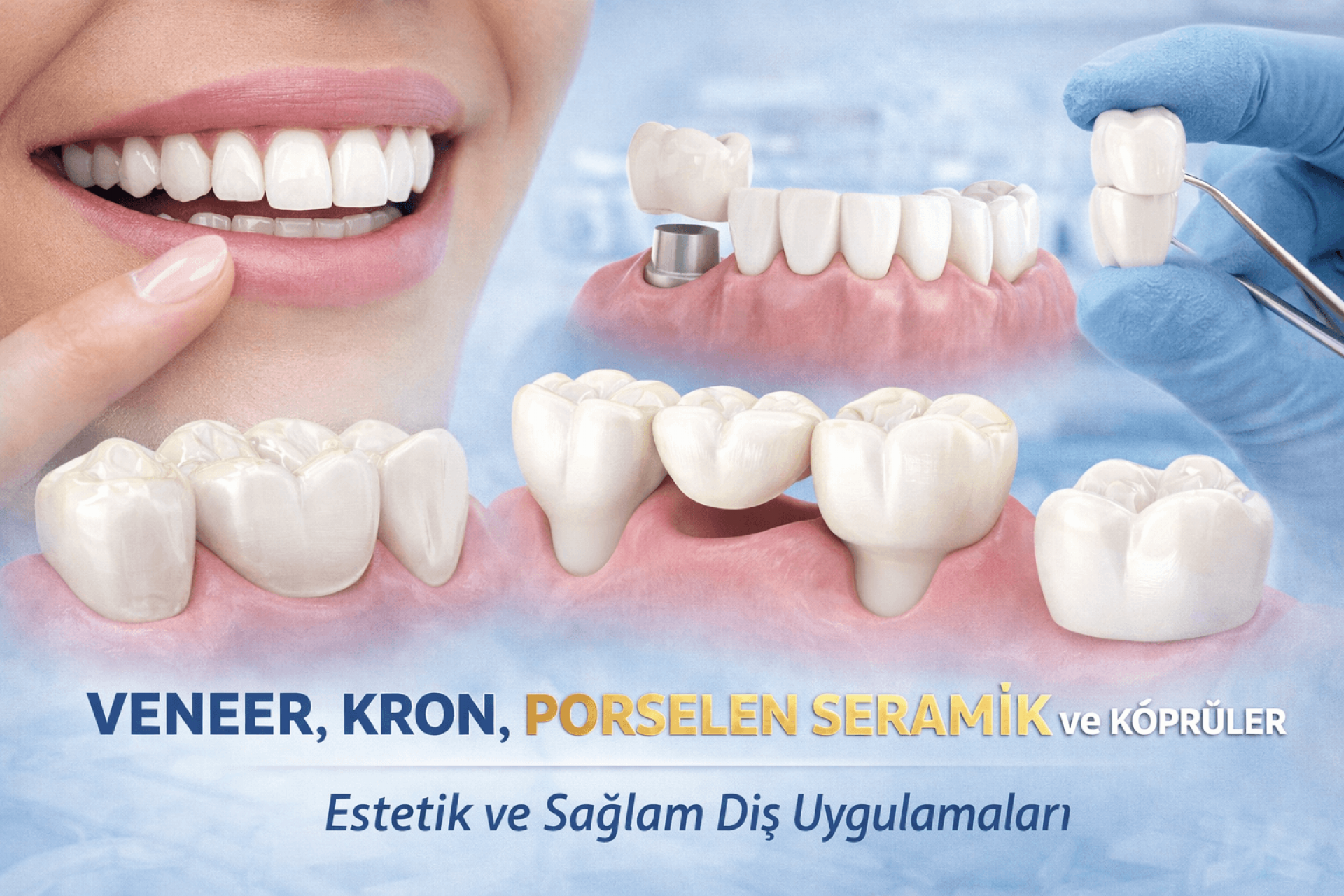 Veneer Kron Porselen (Seramik) ve Köprüler