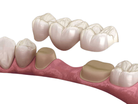 Veneer Kron Porselen (Seramik) ve Köprüler